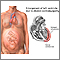 Peripartum cardiomyopathy