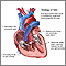 Tetralogy of Fallot