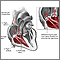 Tricuspid Regurgitation