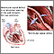 Ventricular septal defect