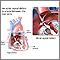 Atrial septal defect