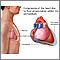 Cardiac tamponade