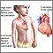 Coarctation of the aorta