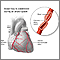 Coronary artery spasm