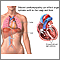 Dilated cardiomyopathy