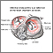 Infective endocarditis