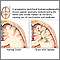 Leukoencephalopathy