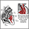 Mitral valve prolapse