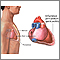 Pericarditis