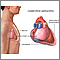 Constrictive pericarditis