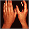 Erythema multiforme, circular lesions - hands