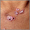 Lupus, discoid  - view of lesions on the chest