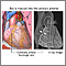 Dye in coronary artery