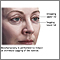 Blepharoplasty - series