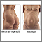 Liposuction - series