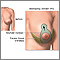 Breast lift (mastopexy) - series