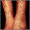 Ichthyosis, acquired - legs