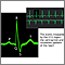 Normal sinus rhythm