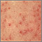 Keratosis pilaris - close-up