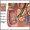 Biliary obstruction - series