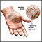 Compression of the median nerve