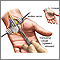 Carpal tunnel surgical procedure