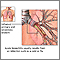 Cause of Acute Bronchitis