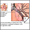 Cause of Chronic Bronchitis