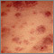 Acute Monocytic Leukemia - Skin