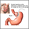 Adjustable gastric banding