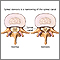 Spinal stenosis