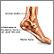 Plantar fasciitis