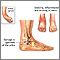 Ankle sprain