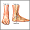 Ankle sprain - series