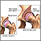 Arthritis in hip