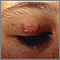 Granuloma annulare on the eyelid