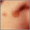 Urticaria pigmentosa in the armpit