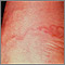 Cutaneous larva migrans