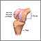 Partial knee replacement - series