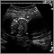 Ultrasound, normal fetus - abdomen measurements