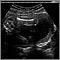 Ultrasound, normal fetus - femur measurement