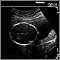 Ultrasound, normal fetus - head measurements