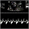 Ultrasound, normal fetus - heartbeat