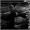 Ultrasound, normal fetus - arms and legs