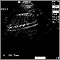 Ultrasound, normal fetus - spine and ribs