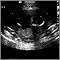 Ultrasound, normal fetus - ventricles of brain