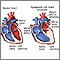 Hypoplastic left heart syndrome