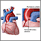 Aortopulmonary window