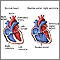 Double outlet right ventricle