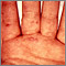 Hand, foot, and mouth disease on the hand